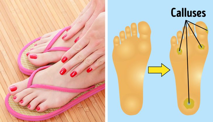 รองเท้าแตะอาจสร้างปัญหาร้ายแรงให้กับข้อเท้าของคุณ
